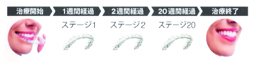 アライナー使用の流れ