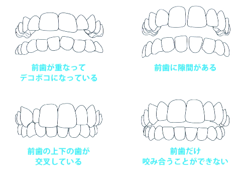 歯並びの種類
